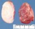 Desmoid fibromatosis. Macroscopy.