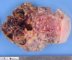 Hypodermal cystic lymphangioma