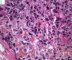 Case 11734: Femoral osteoblastic osteosarcoma
