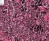 Poorly differentiated neuroblastoma (case 13512)