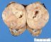 Wilms tumor