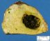 Cystic dilatation of a large bile duct in extrahepatic biliary tract (...)