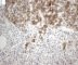 Juxta-trabecular neuroblastic nodule (synaptophysin immunostaining)