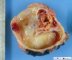 VHL-associated cystic renal cell carcinoma
