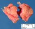 Pancreatic heterotopia in the gastric wall