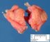 Pancreatic heterotopia in the gastric wall