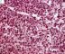 Bone marrow infiltration by large myeloid cells in Kostmann (...)