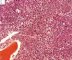 Bone marrow infiltration by large myeloid cells in Kostmann (...)