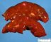 Hepatoblastoma in Beckwith-Wiedemann syndrome