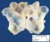 Popliteal synovial cyst