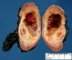 Post-chemotherapy Wilms tumor