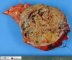Pancreatic solid pseudopapillary tumor