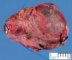 Thyroid follicular adenoma