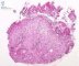 Infantile myofibromatosis: duodenal localization