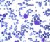Parvovirus B19 cytopathogenic effect in bone marrow