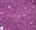 Precursor B lymphoblastic lymphoma
