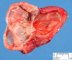 Cystic adrenal in in Beckwith-Wiedemann syndrome (fetus 27 weeks)