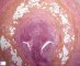 Acute appendicitis