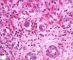 Nuclear and cytoplasmic inclusions in CMV fetopathy
