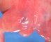 Anal imperforation (anal atresia)