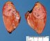 Small hepatoblastoma