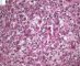 Splenic spumous macrophagic infiltration (Mycobacterium avium infection in (...)