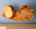 Adrenal metastasis of a neuroendocrine carcinoma