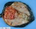 Cystic malignant rhabdoid tumor
