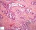Mucoepidermoid carcinoma