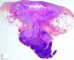 Adenocutaneous fistula in a mycobacterial adenitis