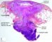 Adenocutaneous fistula in a mycobacterial adenitis