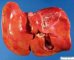 Hepatic necrosis in adenoviral hepatitis