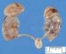 Bilateral non-obstructive multicystic renal dysplasia (BNOMRD)