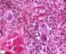 Nuclear and cytoplasmic inclusions in CMV fetopathy