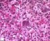 Nuclear and cytoplasmic inclusions in CMV fetopathy