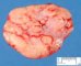Classical Hodgkin disease type scleronodular