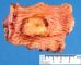 Intestinal Burkitt lymphoma
