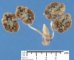 Fetal oligocystic kidneys of unknow cause (case 11389)