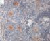 Poorly differentiated neuroblastoma (case 13512)