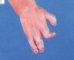 Hand oligodactyly