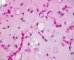Myxoid liposarcoma