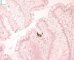 Adenoviral colonic infections