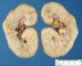 ARPKD kidney in a neonate (1 month)