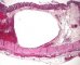 Colonic pneumatosis in cystic fibrosis