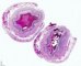 Meconial peritonitis after fetal intestinal perforation in cystic (...)