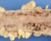 Colonic adenomatous polyposis