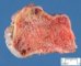 Osteochondroma