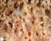 Pulmonary giant cystic chondroid hamartoma