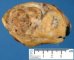 Hepatoblastoma (after formalin fixation)