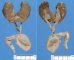 Horseshoe kidney associated with anorectal agenesis and rectovesical (...)